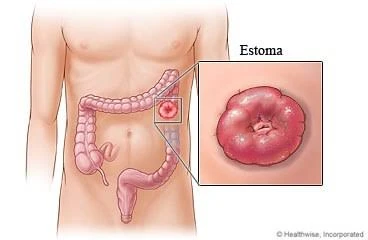 Reconstrução de Colostomia