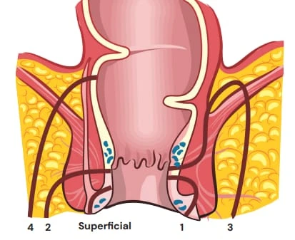 Cirurgia de Fístula e Drenagem de Abscesso Anorretal